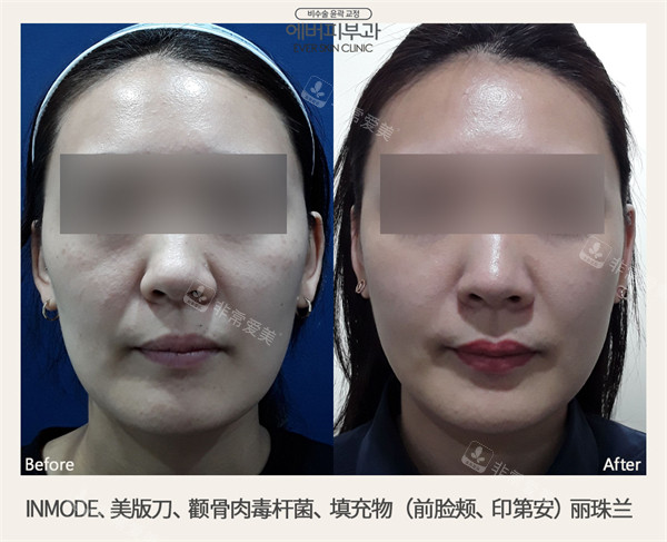 韓國(guó)EVER皮膚科做美超|Inmode|麗珠蘭注射前后對(duì)比