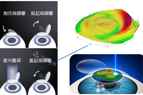 激光近视手术过程示意图