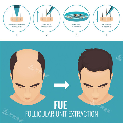 植發(fā)過程 植發(fā)過程