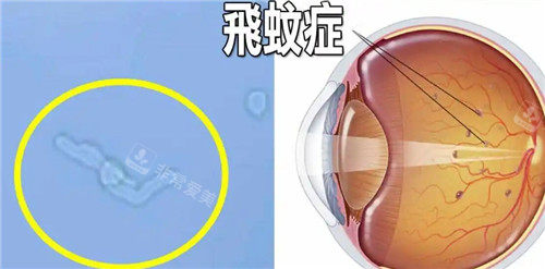 飞蚊症症状图片