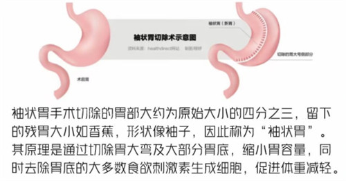 袖狀胃切除手術(shù)原理圖