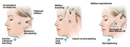 面部提升手術(shù)三種提升方向