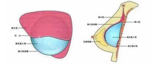 假体隆胸胸部切口卡通示意图