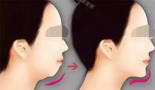 玻尿酸豐下巴后的成效 玻尿酸豐下巴后的成效