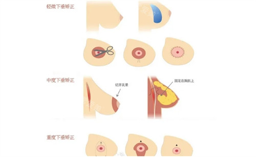 不同胸部狀態(tài)縮胸方式不同