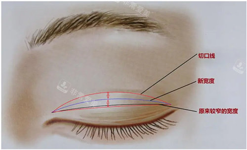 双眼皮肉条修复术原理