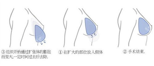 韩国江东圣心医院怎么样?听闺蜜说它家隆胸技术不赖真的假的?