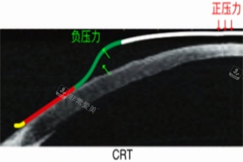 CRT角膜塑形镜力的示意图