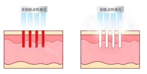 不同类型的点阵激光