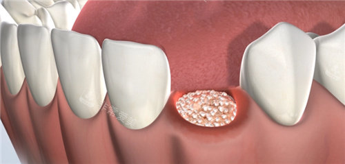 植骨手术动画图片