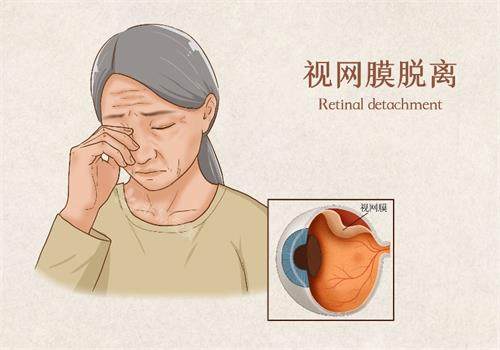 视网膜脱落示意图