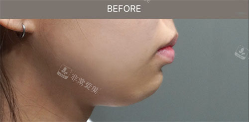 韓國清潭智溫瑜醫(yī)院玻尿酸填充下巴嘴唇術(shù)前圖 韓國清潭智溫瑜醫(yī)院玻尿酸填充下巴嘴唇術(shù)前圖