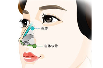 隆鼻側(cè)面卡通示意圖 隆鼻側(cè)面卡通示意圖