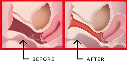 陰道緊縮手術前后對比動畫圖