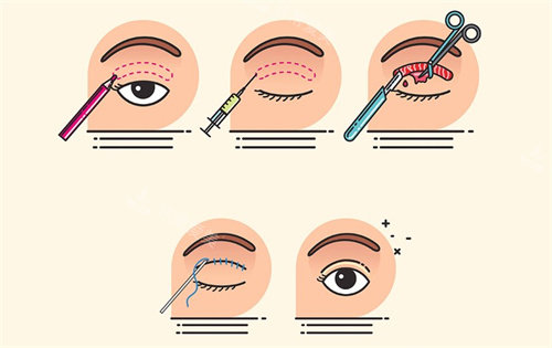 埋线双眼皮过程卡通图