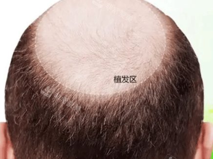 脫發(fā)表現(xiàn)圖 脫發(fā)表現(xiàn)圖