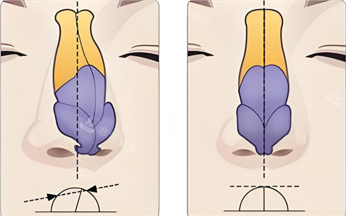 歪鼻矫正术对比图