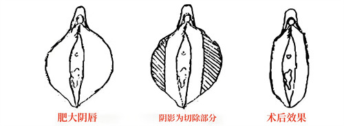 小阴唇肥大直接切除法演示动画图