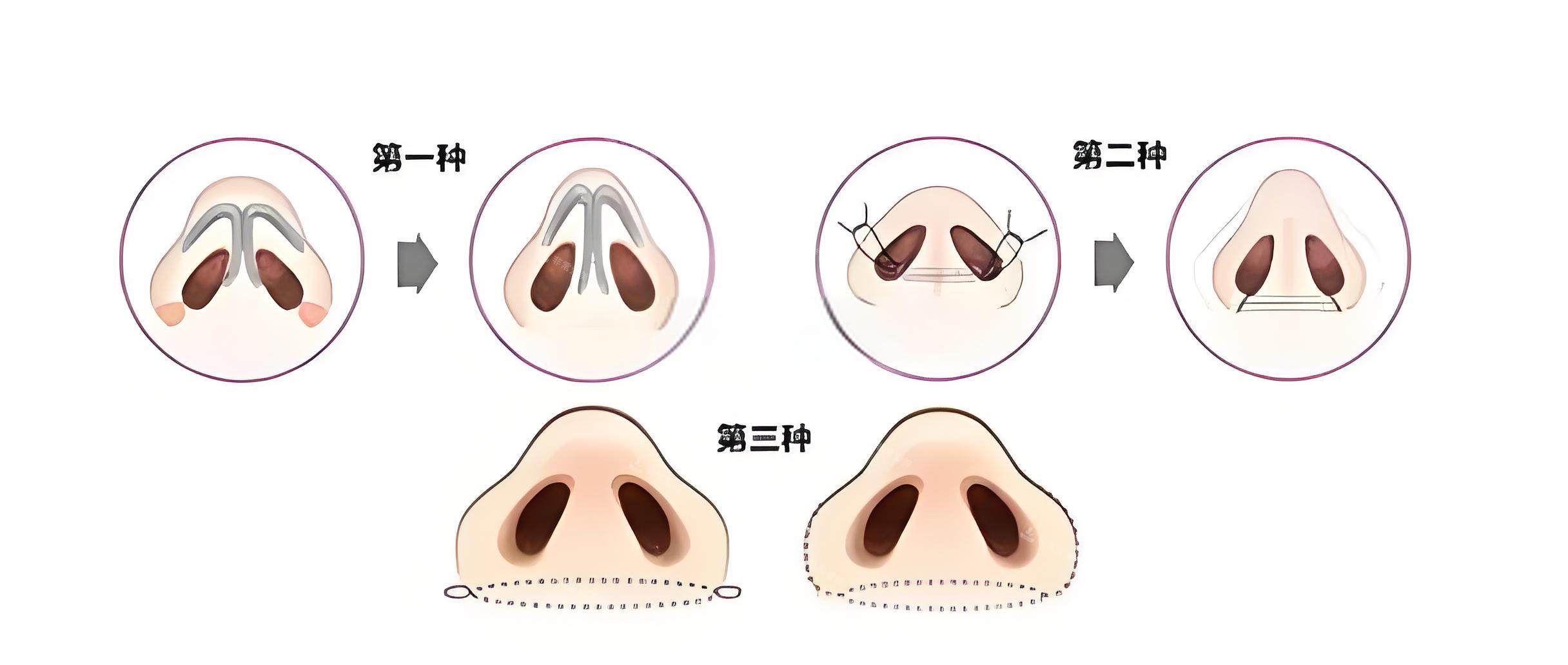 鼻翼手术三种方式图解动画图