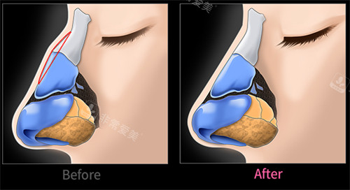 驼峰鼻矫正前后对比