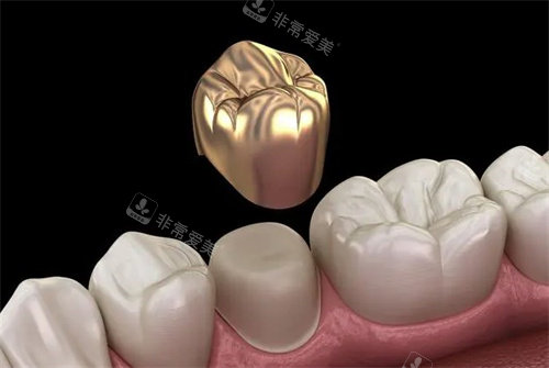 牙冠的材質(zhì) 牙冠的材質(zhì)