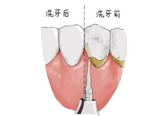 洗牙前后的區(qū)別