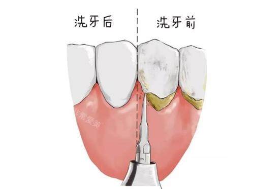 洗牙前后的区别