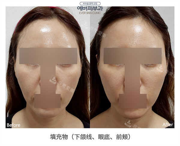韓國EVER皮膚科面部填充前后對(duì)比 韓國EVER皮膚科面部填充前后對(duì)比