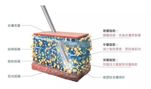 玲瓏體雕吸脂