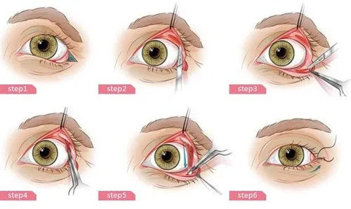 韩国割双眼皮多少钱?分享韩国双眼皮手术价格表!