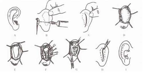 耳朵矫正手术