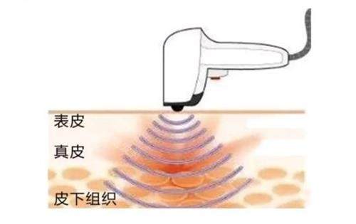 熱拉提針對(duì)的皮膚層