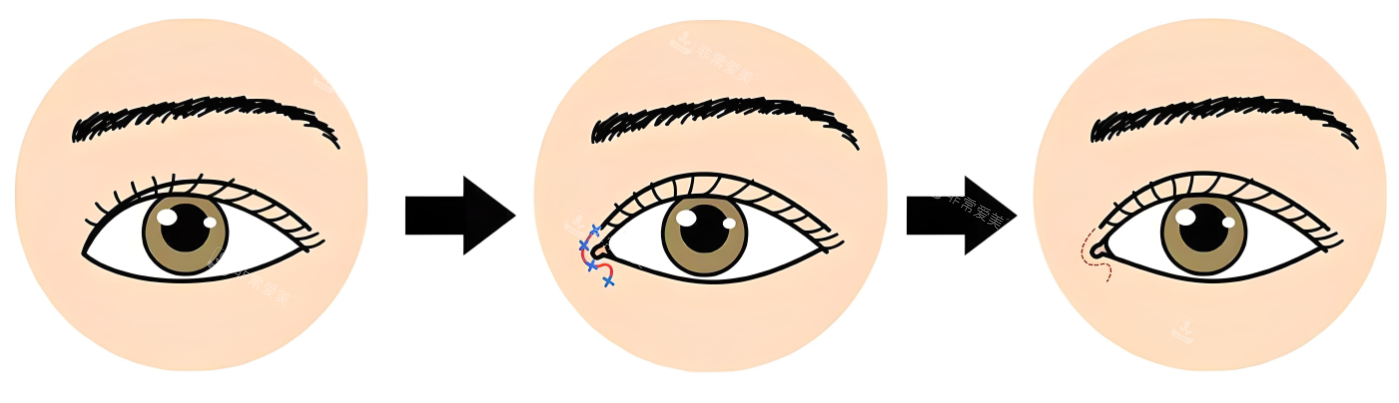 开内眼角术过程