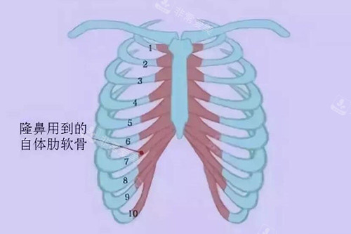 手術(shù)中一般用到的肋軟骨材料