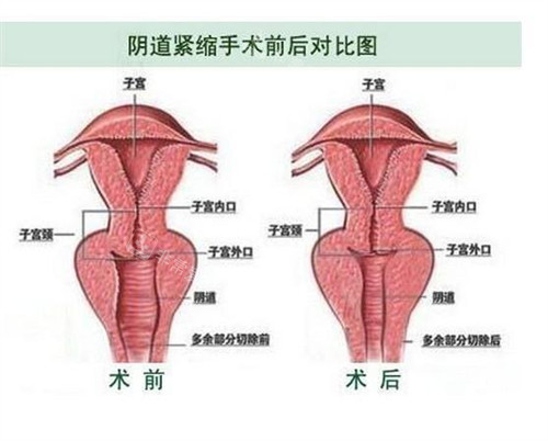 產(chǎn)后去韓國(guó)做了私密整形手術(shù)，改善的特別好后悔沒(méi)早點(diǎn)去！