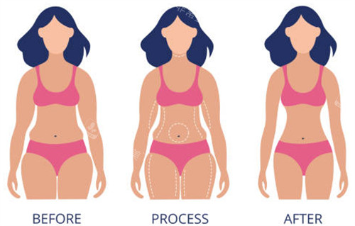 韩国腰腹吸脂好不好?分享我在韩国腰腹吸脂前后对比及经历!