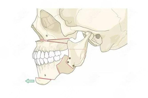 面部輪廓截骨手術示意圖
