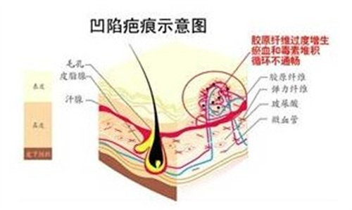 凹陷疤痕