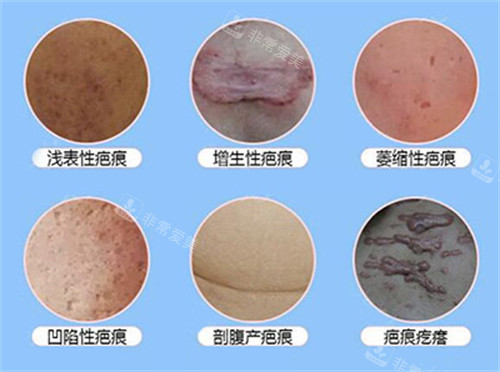 常見(jiàn)的疤痕有哪些 常見(jiàn)的疤痕有哪些
