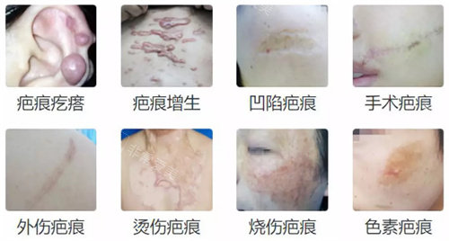 不同疤痕的類(lèi)型 不同疤痕的類(lèi)型