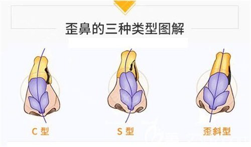 歪鼻的三种类型图解 歪鼻的三种类型图解