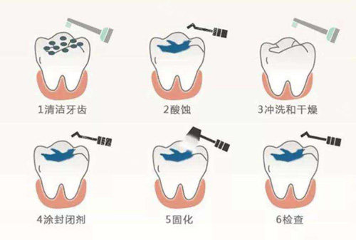 窝沟封闭过程示意图