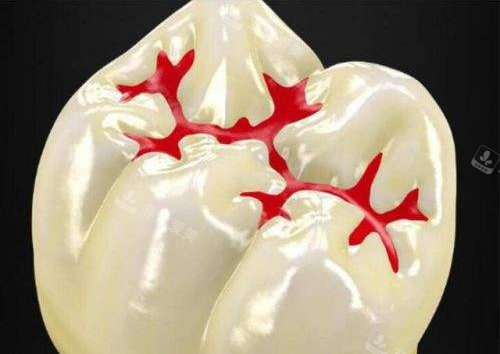 窝沟封闭原理图