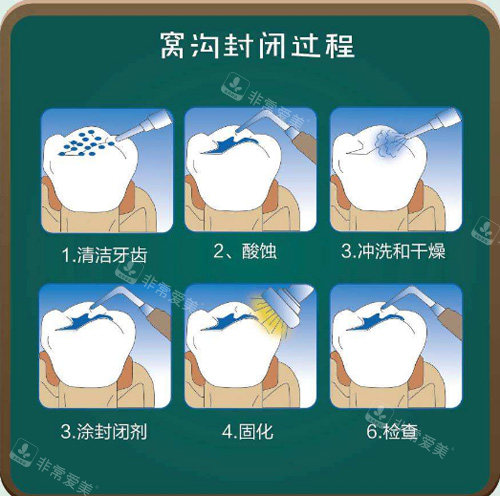 窝沟封闭过程