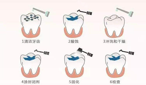 窝沟封闭过程图