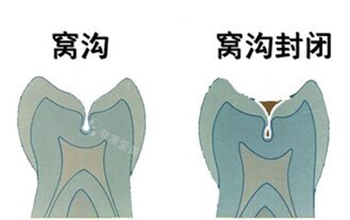 窝沟封闭原理图示