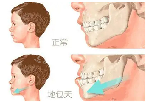 正常咬合和地包天对比