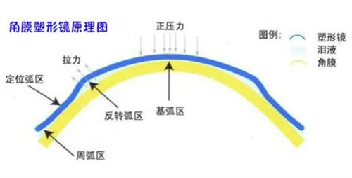 角膜塑形镜原理示意图