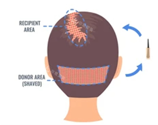 后枕毛囊移植過程圖解