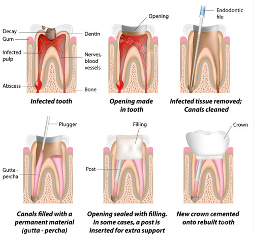 根管治疗过程图